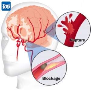 stroke signs